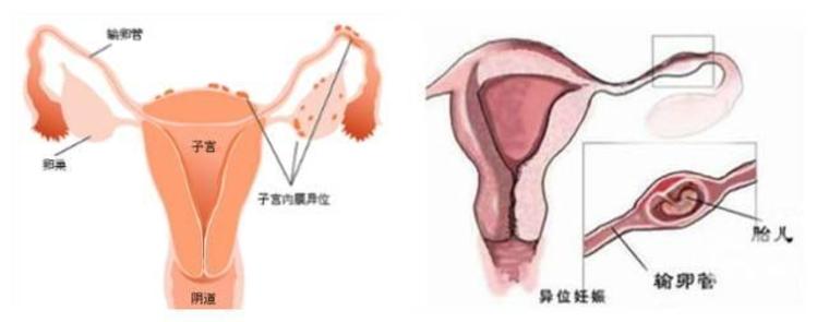 受精卵着床出血