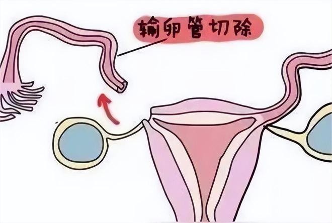 杭州第三代试管婴儿